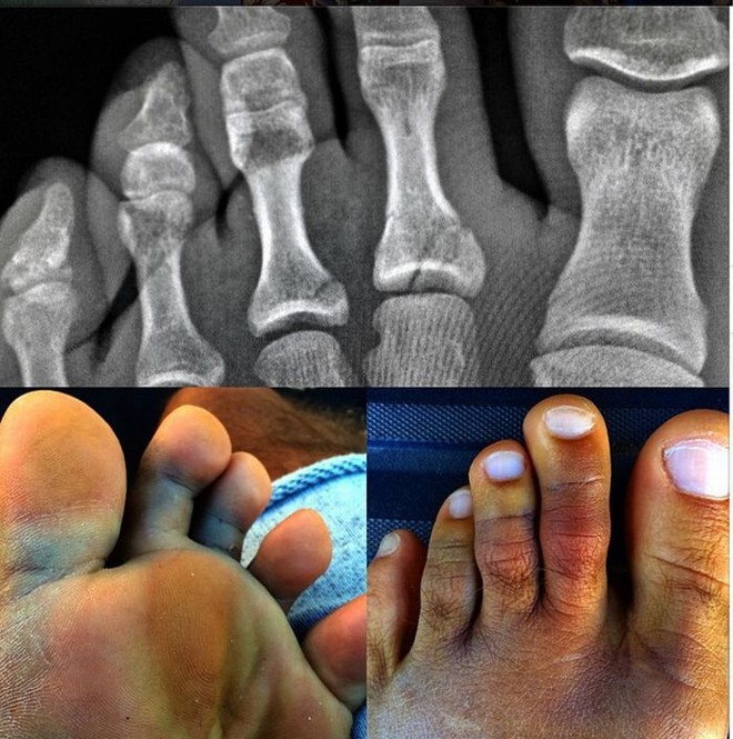 Foto postada por Kelly Slater com os dedos do pé fraturados |