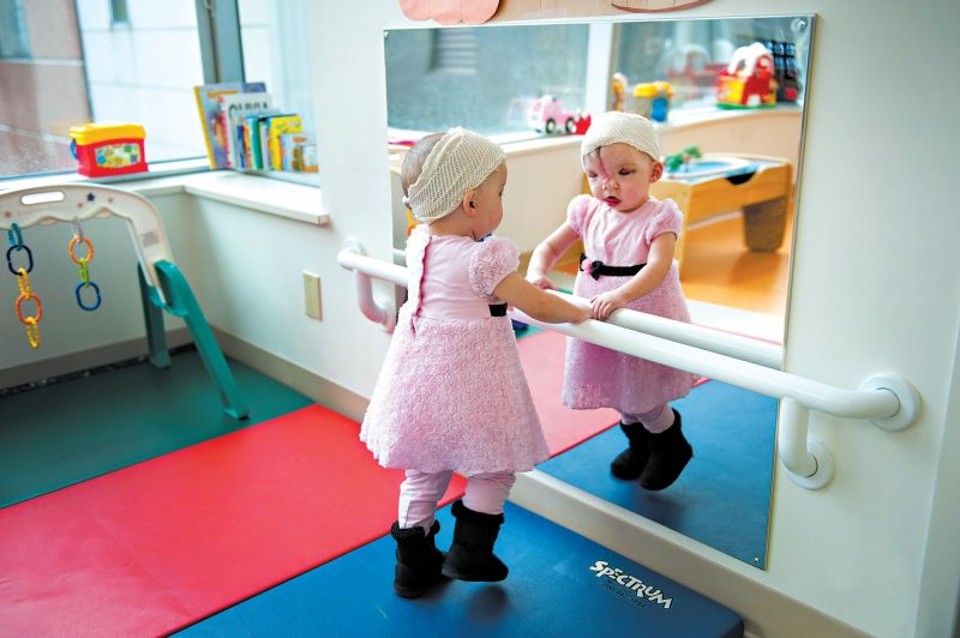 Violet Pietrok após a cirurgia que corrigiu uma fissura facial que deixava seus olhos muito separados | Fotos: Katherine C. Cohen/Boston childrens hospital