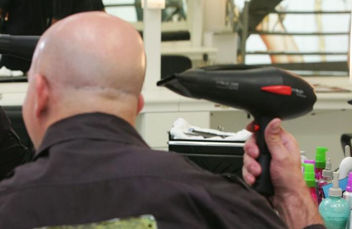 Estudo traz esperanças de novos tratamentos para a calvície e a alopecia - condição que causa a perda de cabelos em áreas delimitadas. | Marcelo Elias/Gazeta do Povo