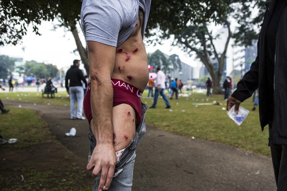 Especialistas questionam uso desmedido de balas de borracha Manifestante mostra as marcas das balas de borracha: excesso. | Brunno Covello/Gazeta do Povo