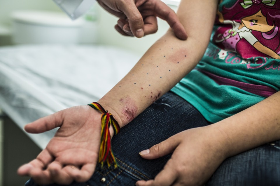 Testes para alergia podem ajudar a identificar os componentes aos quais nosso corpo reage. | Brunno Covello/Gazeta do Povo