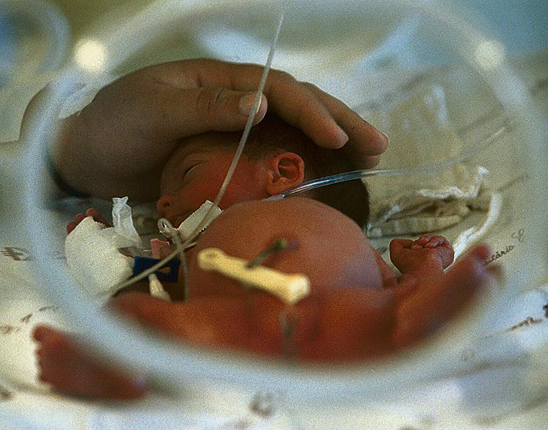 Prematura em UTI: acompanhamento deveria ir até a adolescência. | Jairo Resende