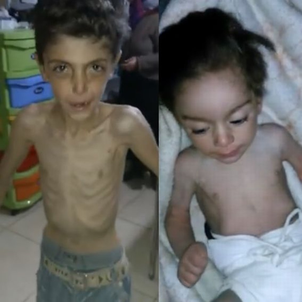 Imagens de crianças desnutridas na cidade síria Madaya divulgadas por médicos de associação americana | Reprodução/Syrian American Medical Society