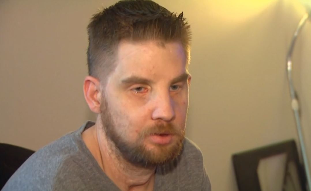 O americano Mitchell Hunter, de 35 anos, mostra seu rosto depois de cinco anos de sucesso da cirurgia facial. | Reprodução/CNN