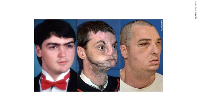 Richard Norris sofreu um acidente com uma arma em 1997, e utilizou uma máscara cirúrgica por 15 anos para esconder seu rosto. Na imagem da direita, Richard após o transplante. |