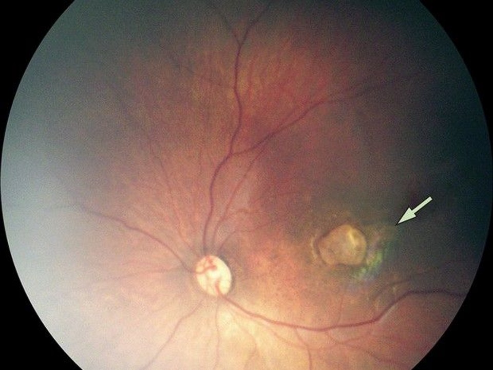 Exame de imagem mostra um caso de atrofia macular grave em bebê com microcefalia. | The Lancet /
