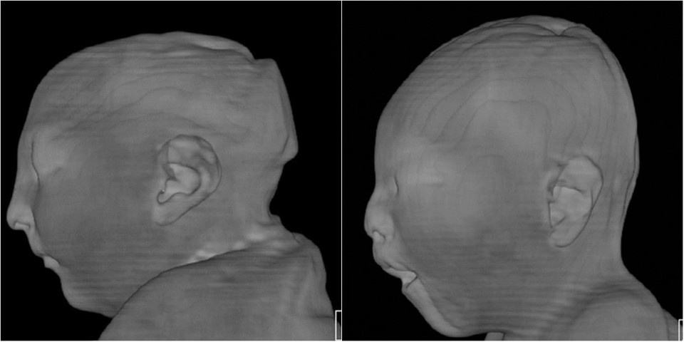 Imagens da pesquisa divulgada na revista Radiology mostram anomalias em cérebro de bebês afetados por infecção do zika | RSNA Radiology / Reprodução