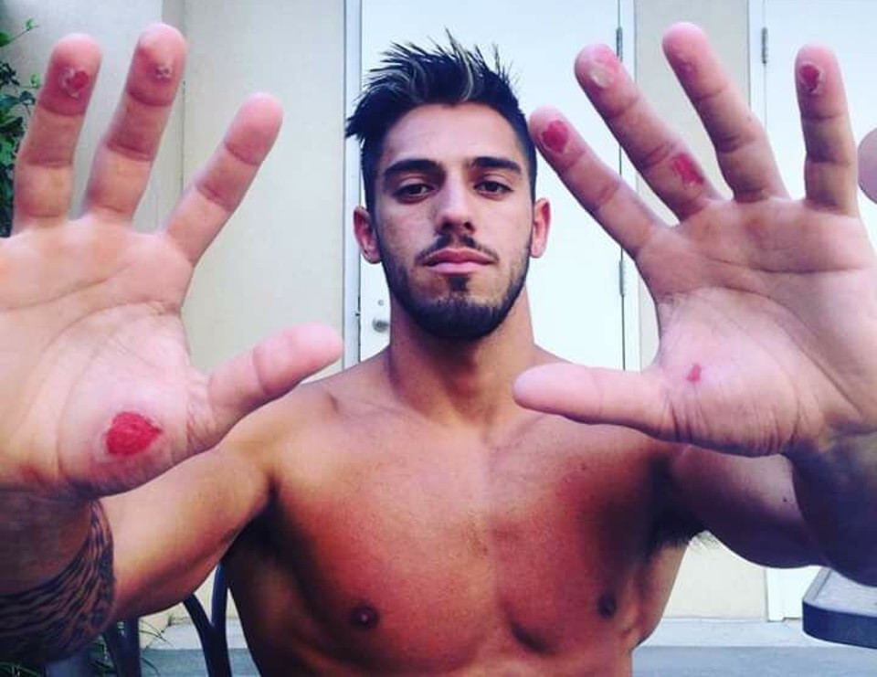Marcelo Munhoz mostra as consequências da primeira fase do Ultimate Beastmaster Netflix. | Arquivo Pessoal/Facebook