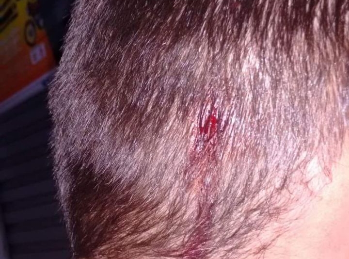 Trabalhador do transporte coletivo postou uma foto em seu Facebook mostrando o ferimento | Reprodução/Facebook