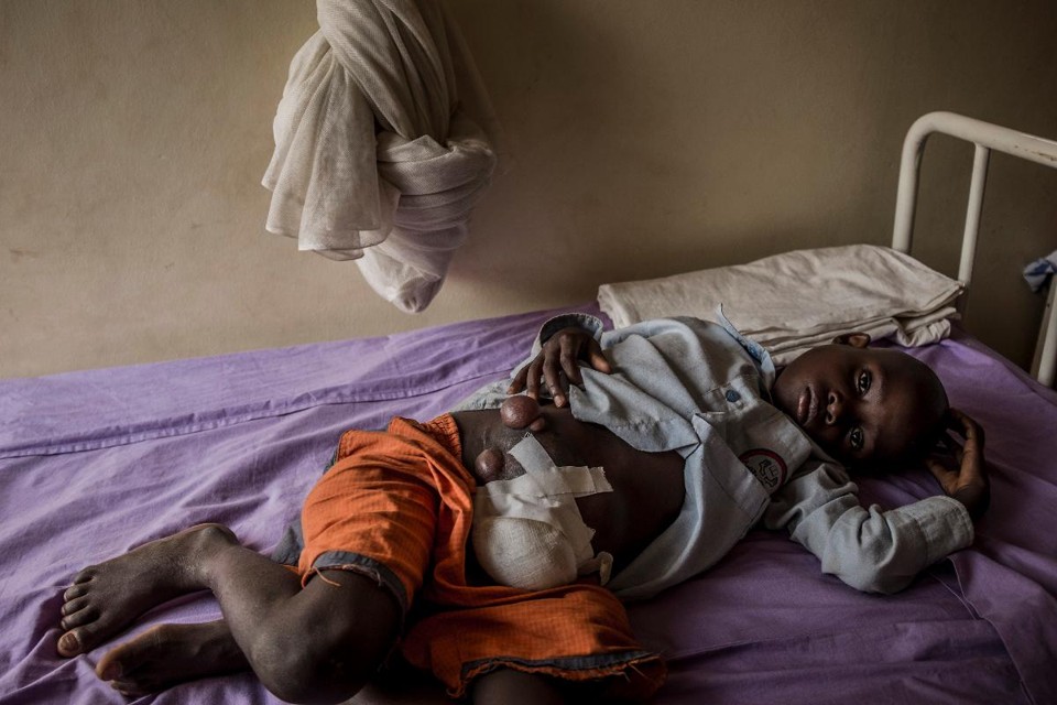 Paul Mugumya,  7, passou por três operações de hérnia até que os cirurgiões perceberam que ele tinha  tumores | CHARLIE SHOEMAKER/NYT