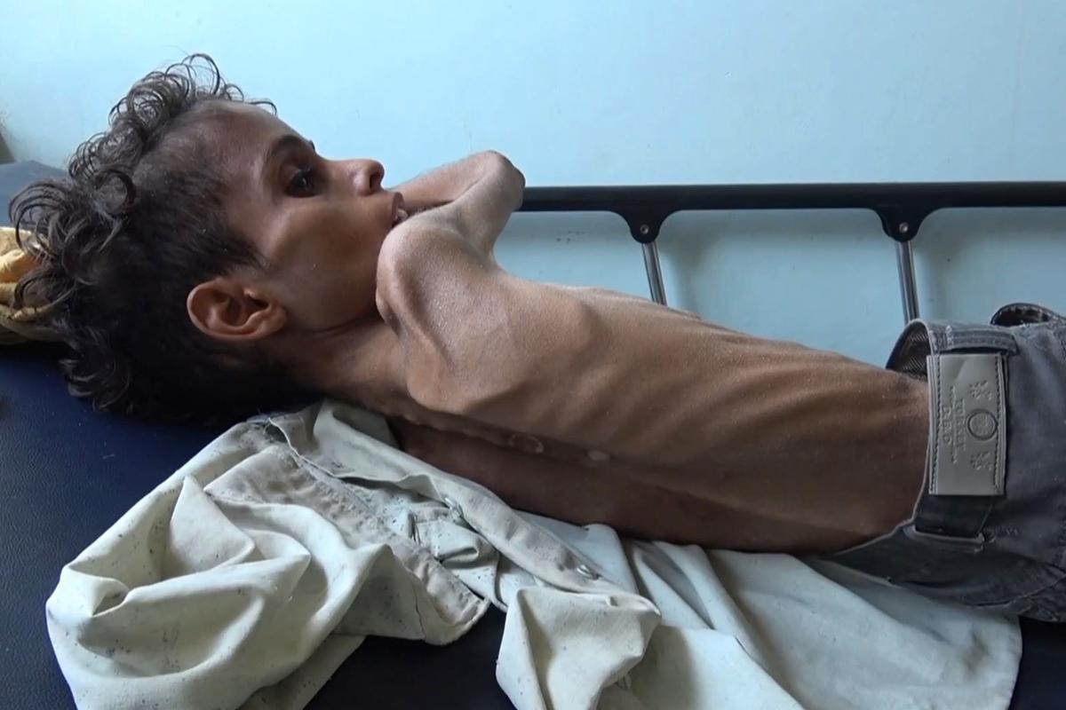 Ghazi Saleh, 10 anos, em uma cama no hospital Al-Mudhafar em Taez, Iêmen. Ele pesa 8 quilos e está muito fraco para se mover ou chorar | MARZOOQ AL-JABIRY / AFP