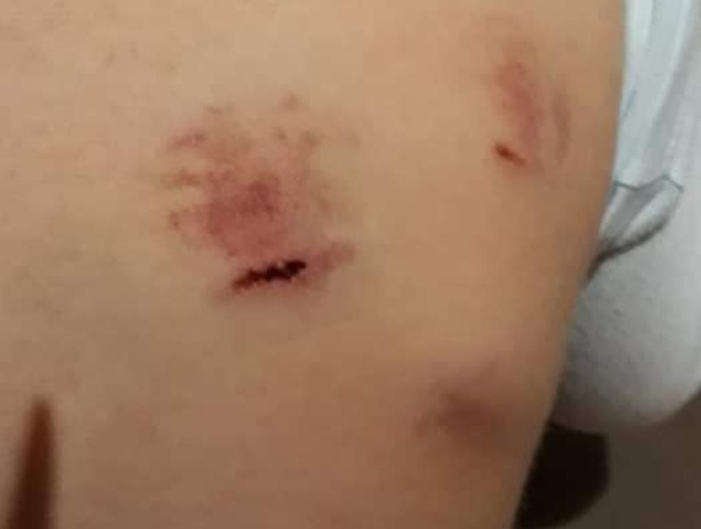 Criança voltou da escola com cerca de dez mordidas pelo corpo. | Reprodução/