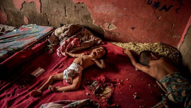 Anailin Nava, 2 anos, sofre de desnutrição e de uma doença neurológica não tratada. A família mora na Ilha de Toas, Venezuela, e sua mãe não tem condições de comprar medicamentos
