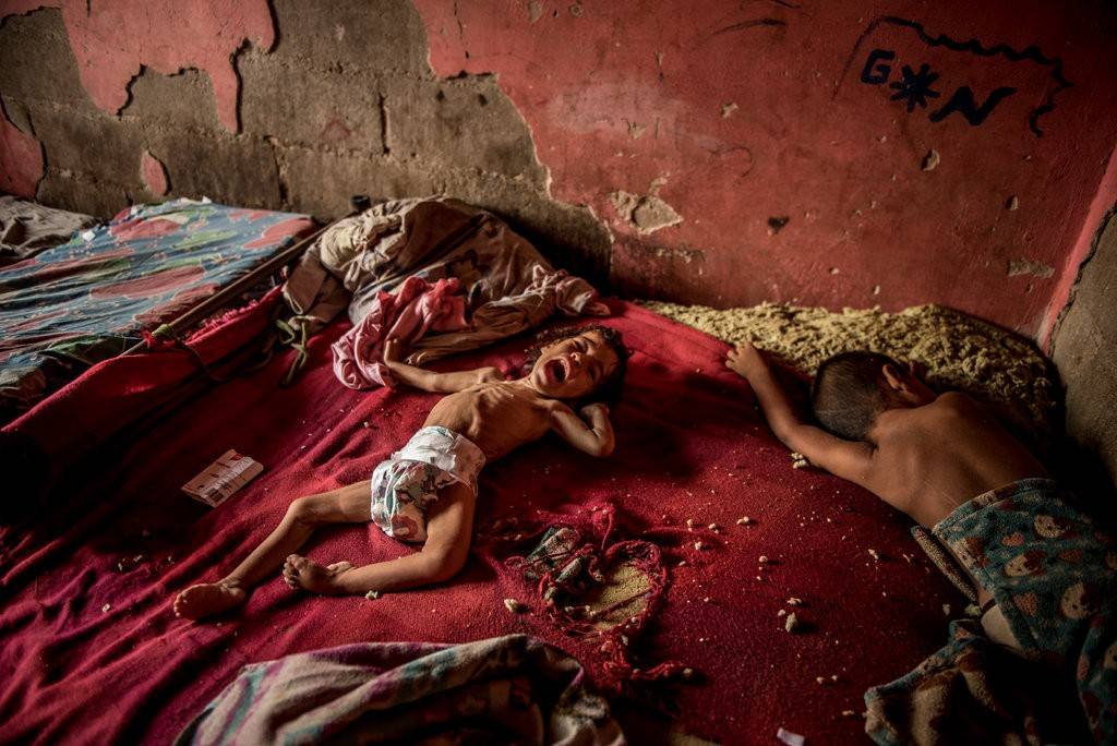 Anailin Nava, 2 anos, sofre de desnutrição e de uma doença neurológica não tratada. A família mora na Ilha de Toas, Venezuela, e sua mãe não tem condições de comprar medicamentos