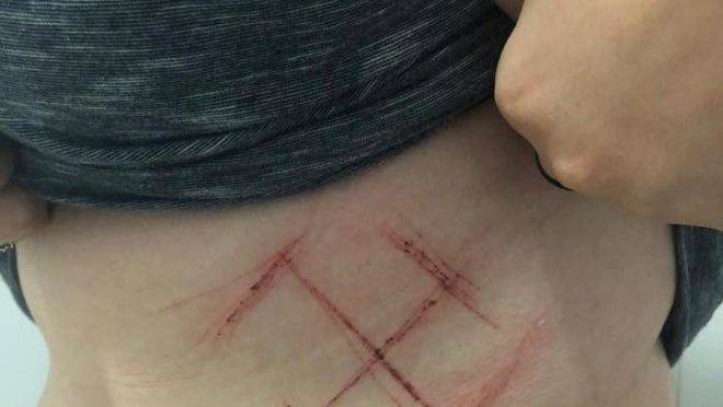 Uma jovem de 19 anos divulgou em sua rede social uma foto de uma suástica que teria sido marcada a força com um canivete em sua barriga: a acusação era fabricada