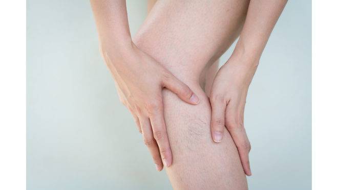 Cirurgia de Varizes: Muito mais do que uma preocupação estética