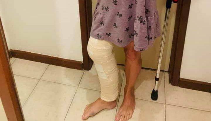 Médica Ticyana teve um joelho quebrado