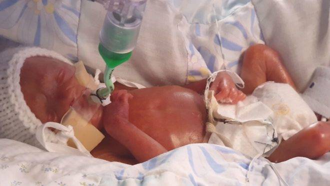 Em 12 semanas de vida, Oliver passou por uma cirurgia para remover 2,5 centímetros do intestino para receber uma bolsa de colostomia