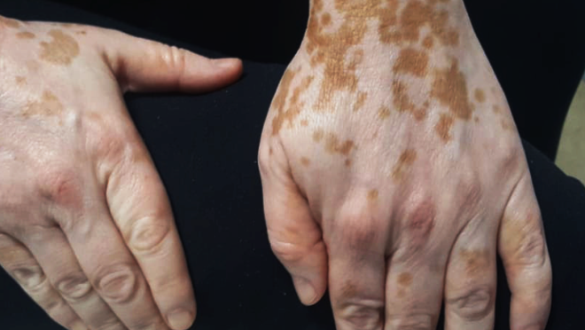 Foto de mulher que tem vitiligo