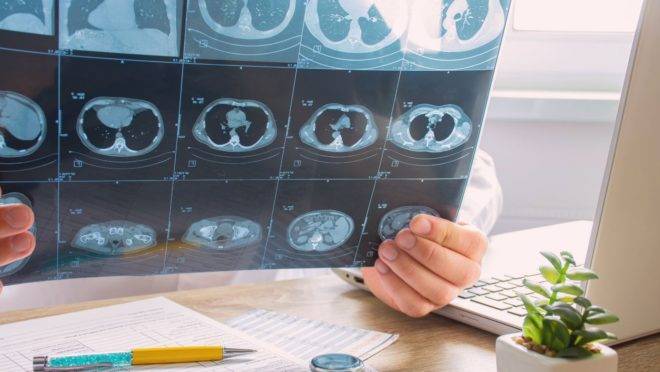 Um dos exames para verificar o avanço da Covid-19 é a imagem do pulmão - cujo câncer é diagnosticado tardiamente em geral