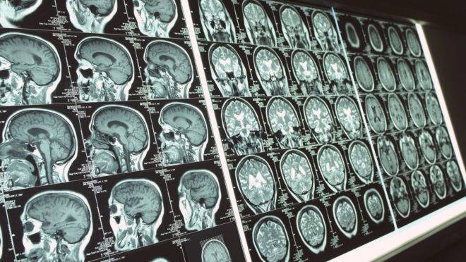 O novo coronavírus, causador da Covid-19, é capaz de invadir o cérebro, concluíram dois estudos brasileiros.