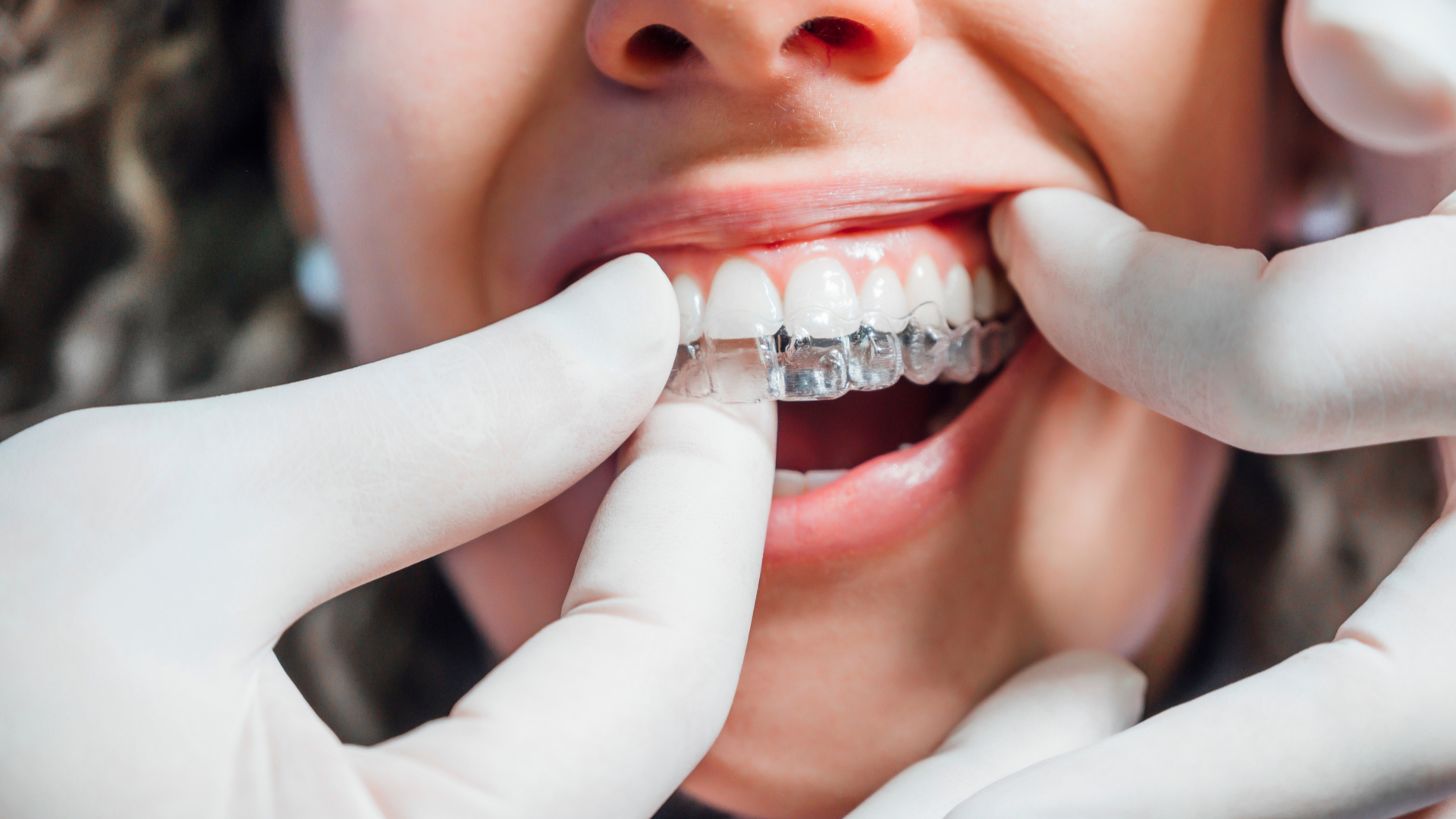 Cuide do seu sorriso com boa aparência e elegância. Conheça o Invisalign ®!