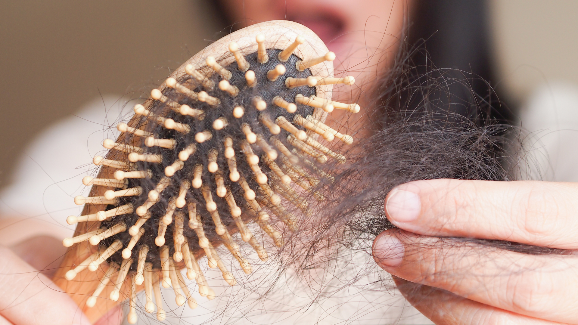 Técnica FUE se destaca por ser pouco invasiva e assegurar naturalidade dos novos fios