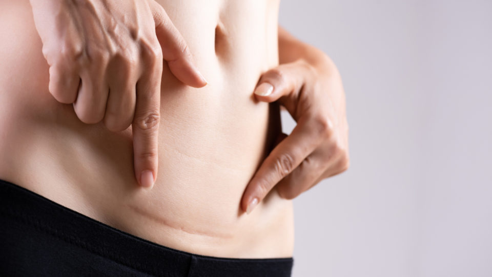 Uma boa cicatrização também leva em conta fatores externos, como higiene e proteção da ferida, e internos, como genética.