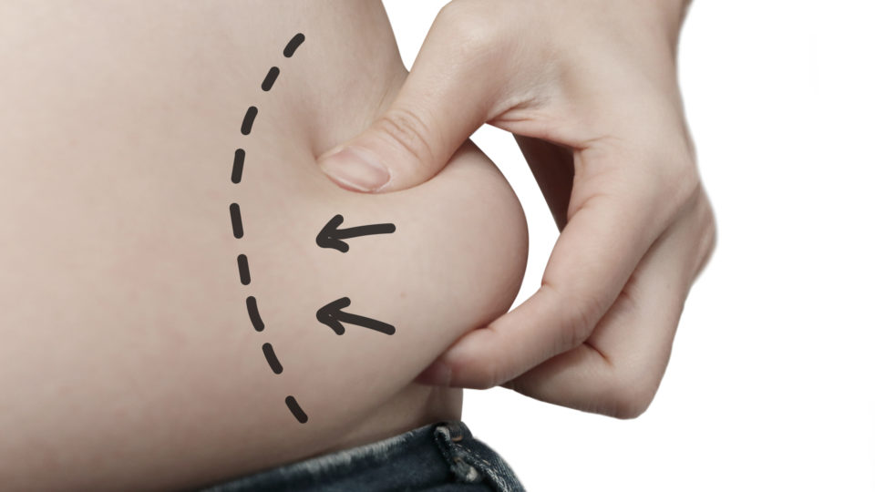 Lipoaspiração é a retirada de excesso de gordura. Abdominoplastia é a retirada de excesso de pele.