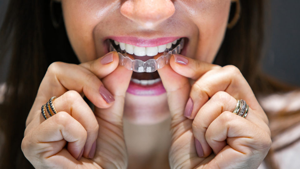 Os aparelhos transparentes do modelo Invisalign® são praticamente imperceptíveis