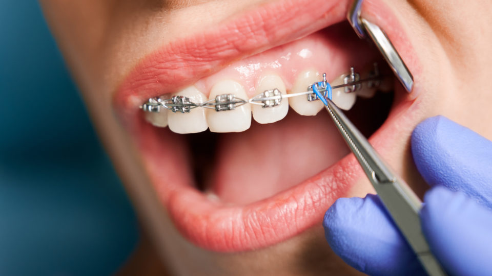 Os aparelhos fixo metálicos necessitam de manutenção periódica, no consultório do dentista, para ajustar ou trocar braquetes soltos ou fios