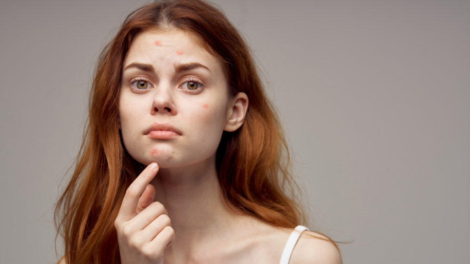 A terapia fotobiodinâmica é utilizada para tratamento de problemas de pele como a acne.