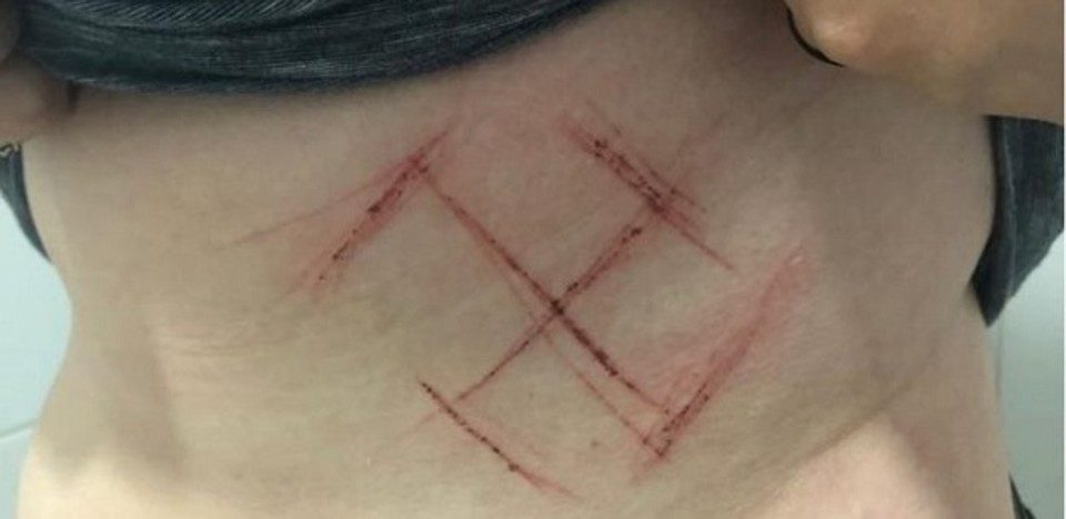 Os cancelamentos são artificiais e eleitoreiros Em 2018, a Polícia do Rio Grande do Sul concluiu que jovem marcada com suástica na pele forjou o crime.