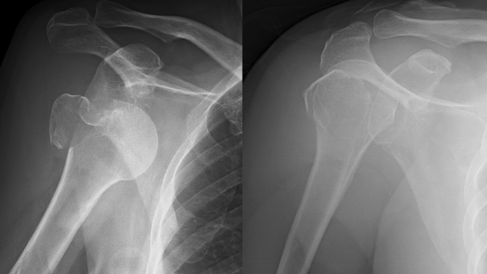 O ombro deslocado é comum na prática esportiva e pode precisar de cirurgia