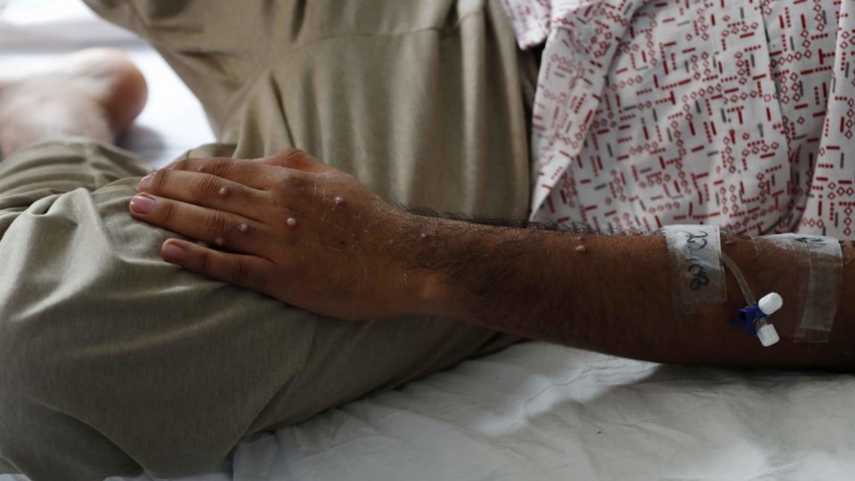 OMS suspende emerg&ecirc;ncia por var&iacute;ola de macaco ap&oacute;s 10 meses