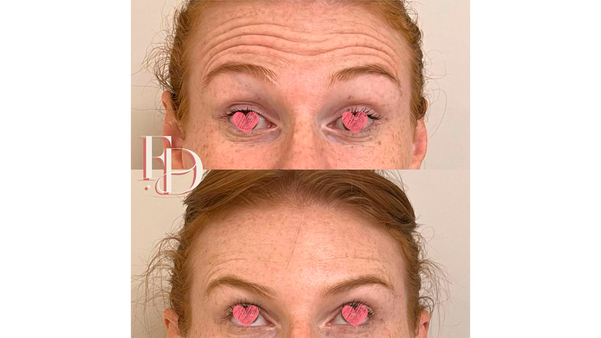 A qualidade da toxina, hábitos de vida e outros fatores influenciam no tempo que dura o botox.