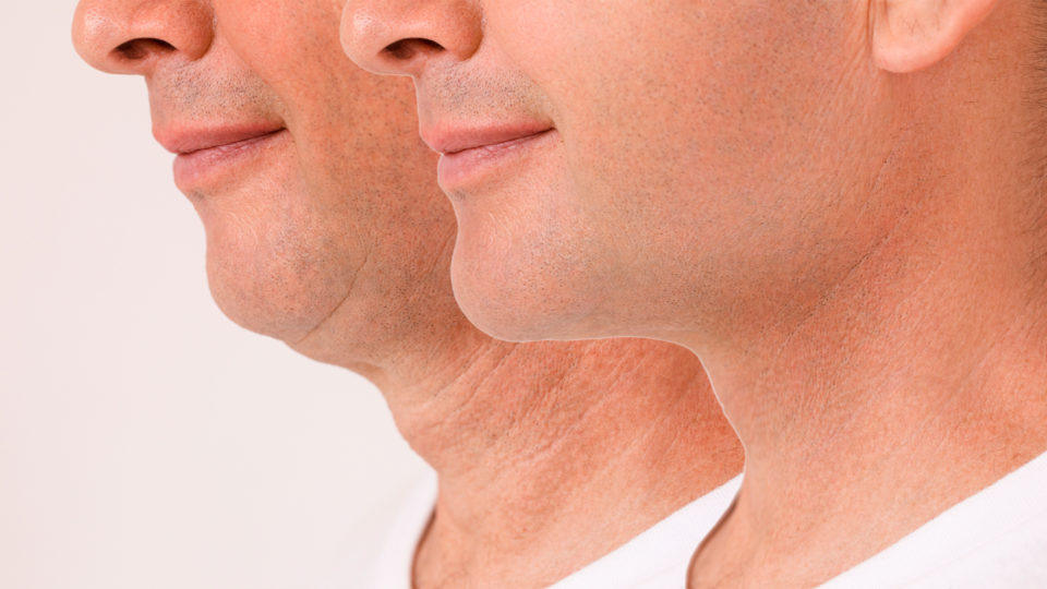 Um dos resultados da harmonização facial é a mudança do tamanho do queixo.