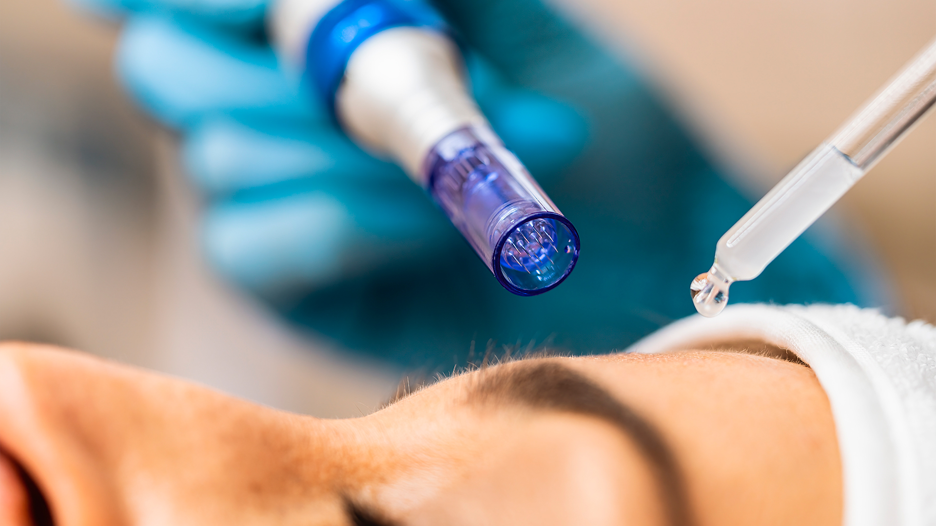 O microagulhamento e peeling para manchas de pele são procedimentos estéticos que podem ser usados em conjunto