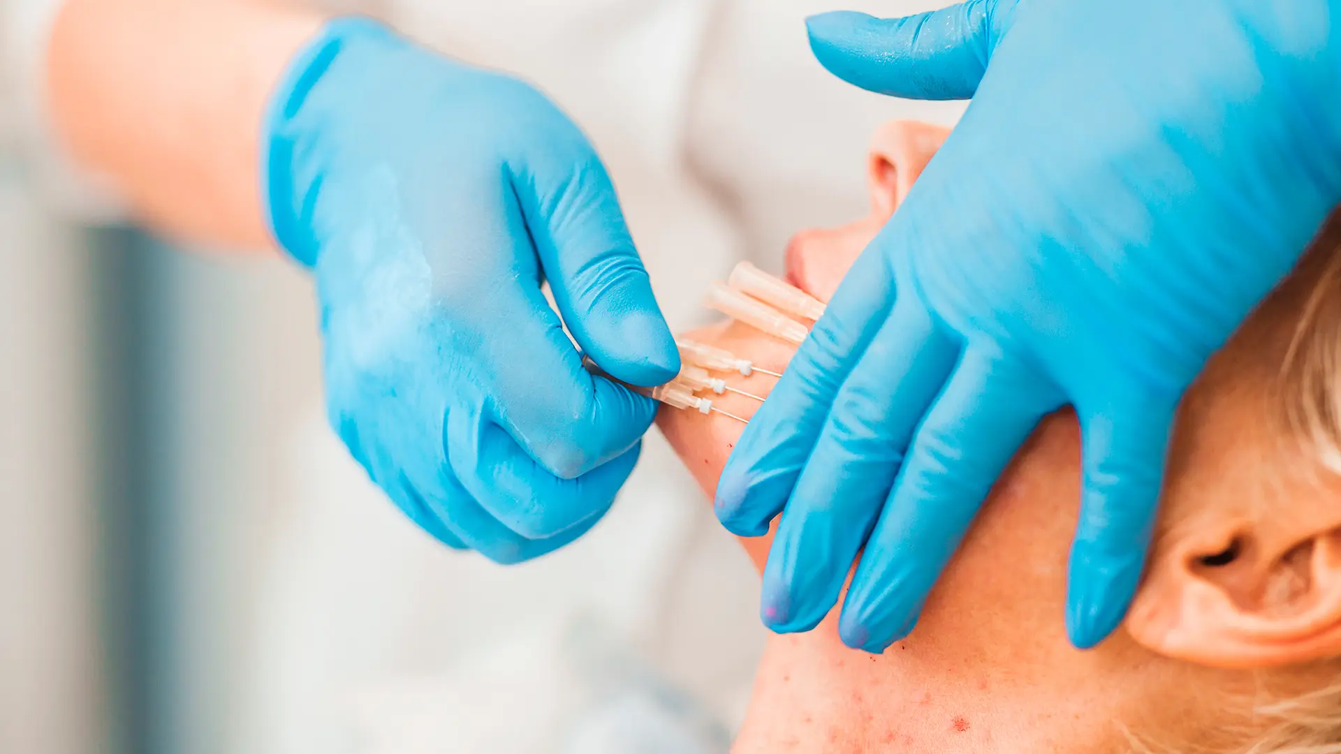 Bioestimuladores de colágeno ajudam a deixar a pele mais firme e hidratada