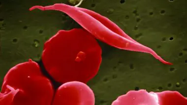 Doença genética da anemia falciforme altera hemoglobina e gera células vermelhas do sangue em formato de foice (acima na imagem, células normais abaixo — a cor é artificial aplicada sobre imagem de microscópio eletrônico). Cura é a primeira da história.
