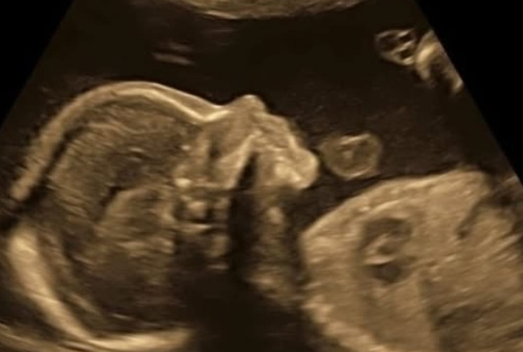 O remédio apresentado pelo PSOL esta semana como &#8220;reconhecidamente seguro” para realização de “abortos legais” pode falhar em 1 a cada 10 casos