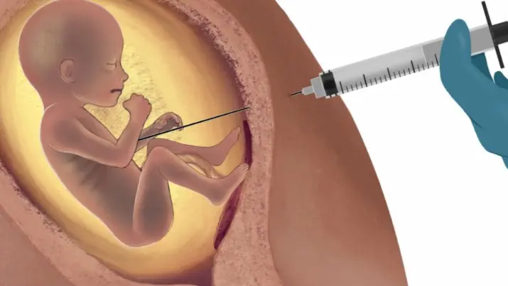 Após cinco meses de gestação, os bebês são mortos por meio da assistolia fetal, que injeta uma droga para causar a parada cardíaca fetal