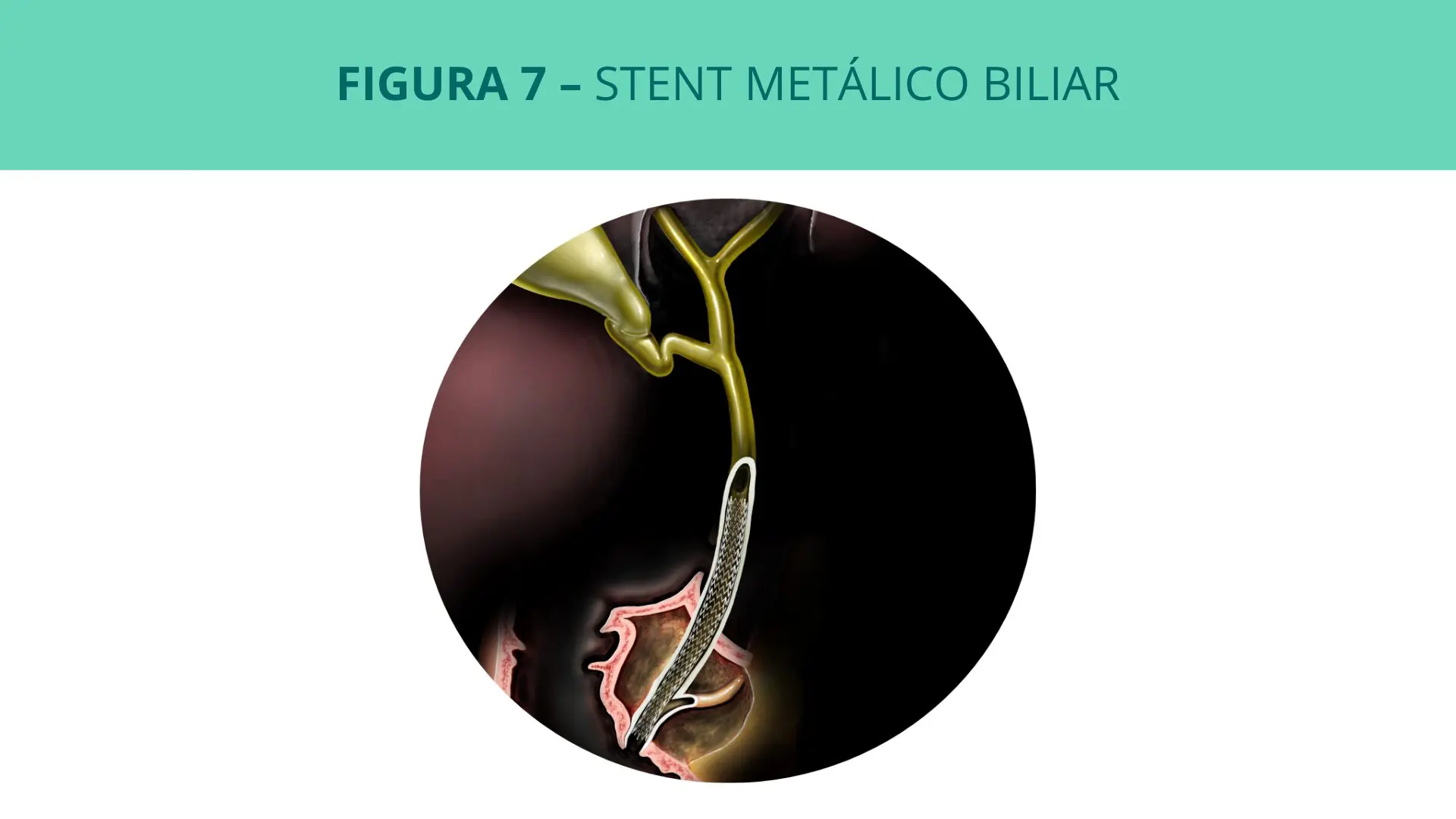 Stent metálico biliar