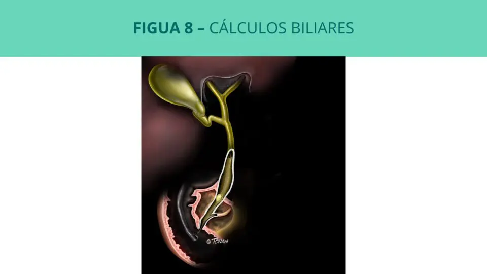 Cálculos biliares