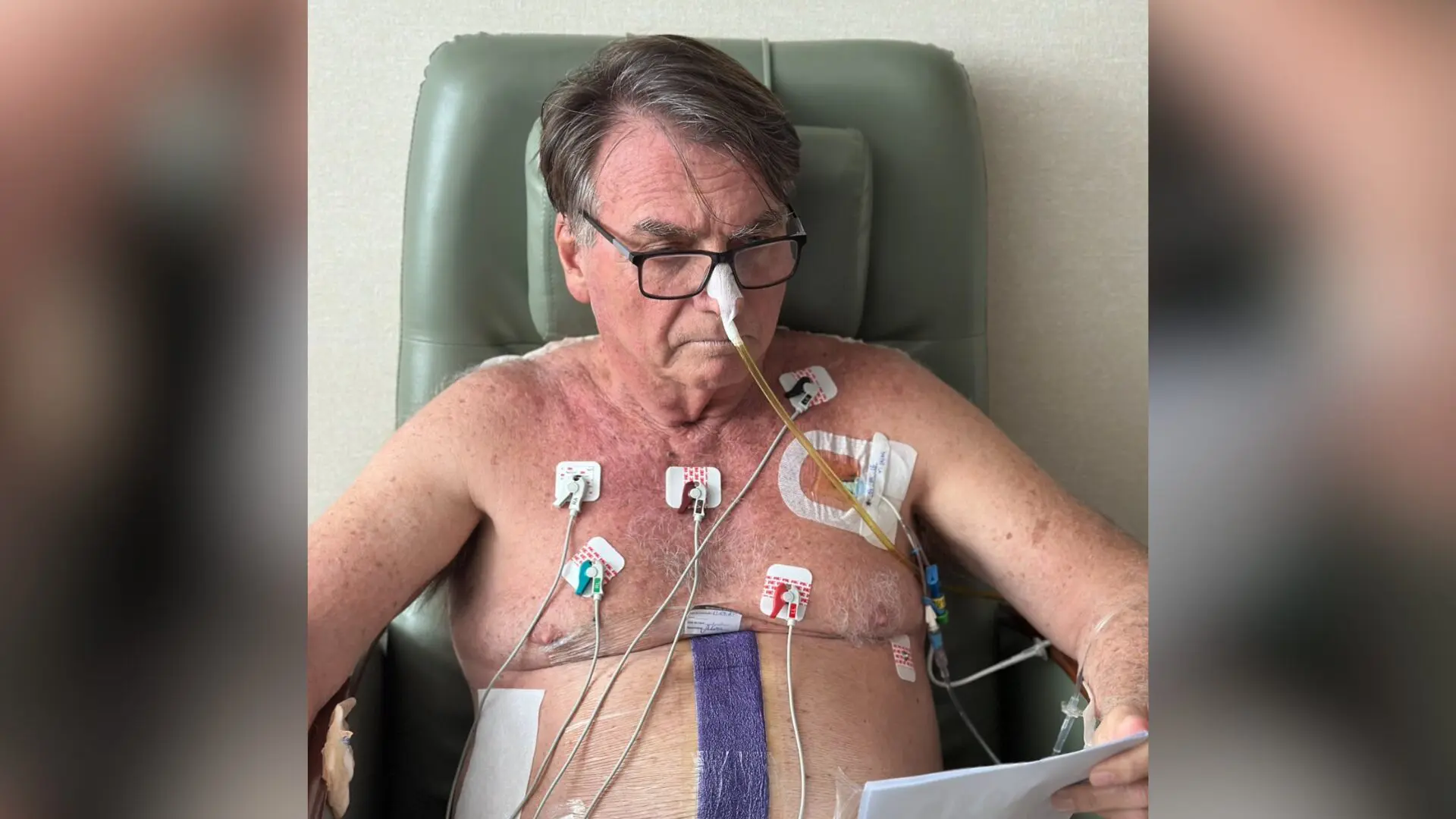 O ex-presidente Jair Bolsonaro (PL) apresentou evolução clínica, segundo novo boletim médico.