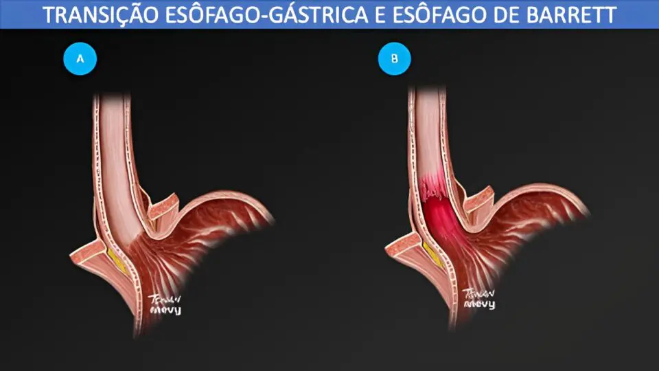 Transição esôfago-gástrica. a.anatomia normal; b.esôfago de Barrett