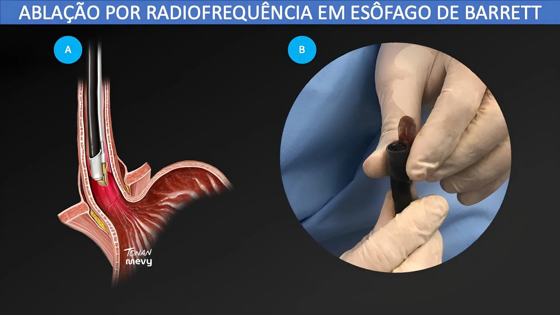 Ablação por radiofrequência em esôfago de Barrett