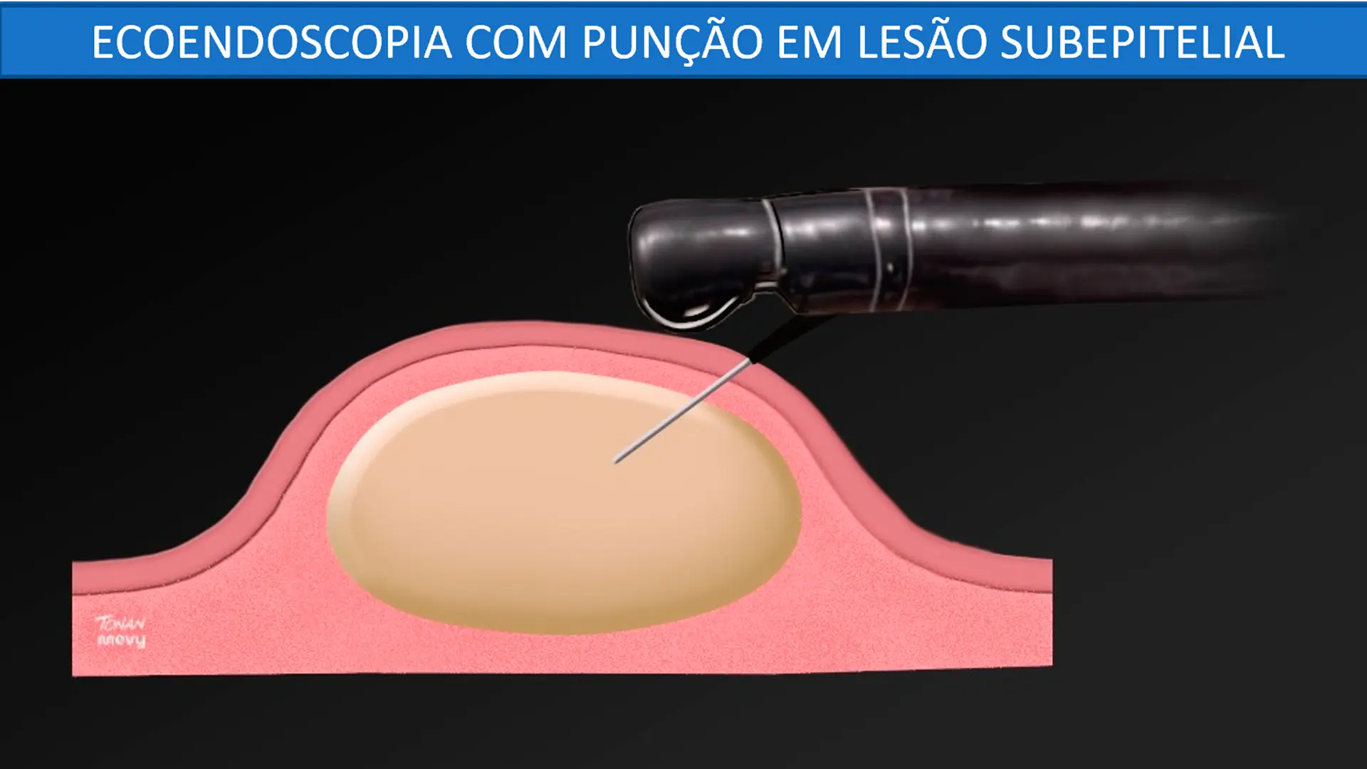 Ecoendoscopia com punção de lesão subepitelial gastrointestinal.