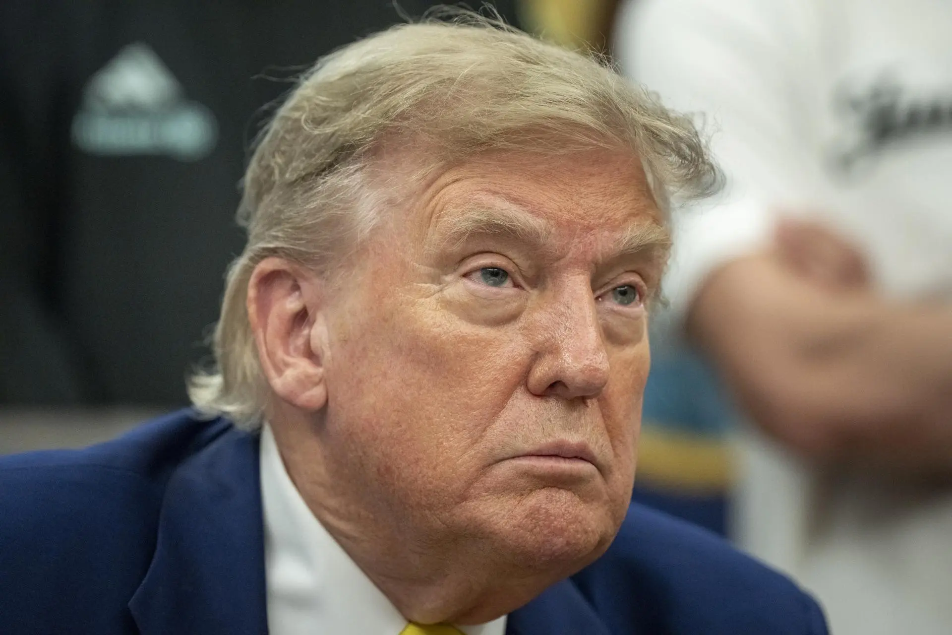 Donald Trump foi diagnosticado com Insuficiência Venosa Crônica