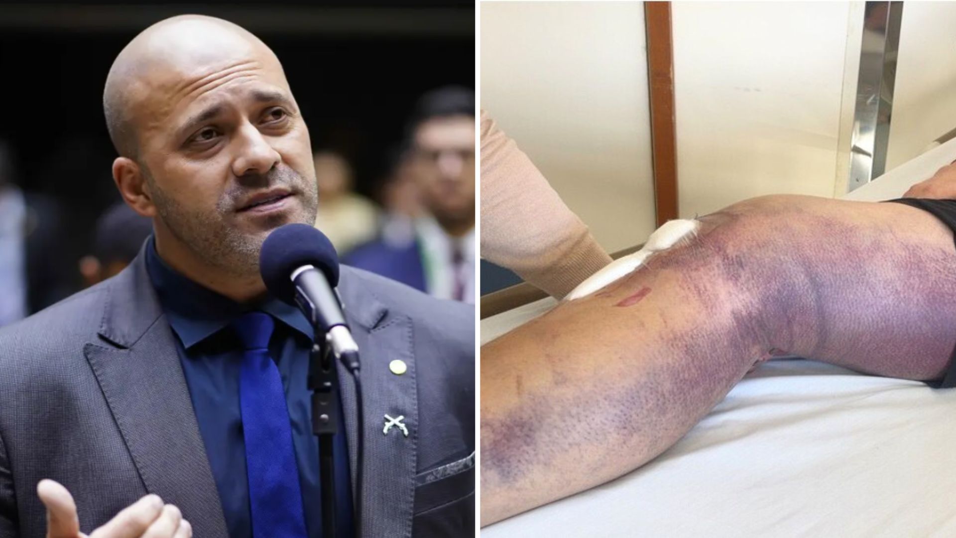 Advogados de Daniel Silveira apontam quadro de dores e febre constante após cirurgia no joelho